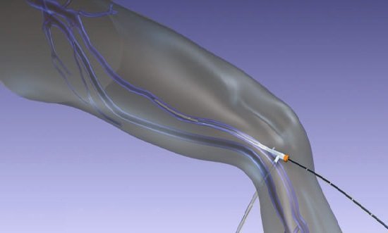 Laser procedure