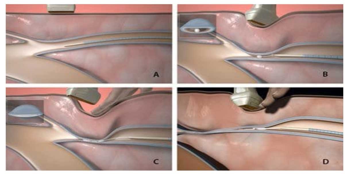 Micro-phlebectomy